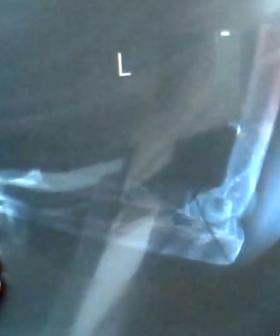 Amanda Keller Shows Us Her X-Rays LIVE On The Show!