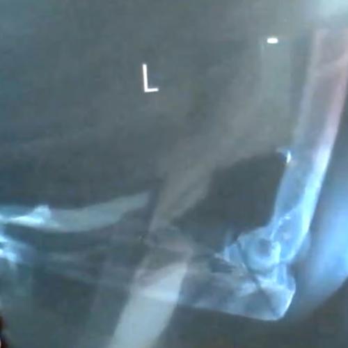 Amanda Keller Shows Us Her X-Rays LIVE On The Show!